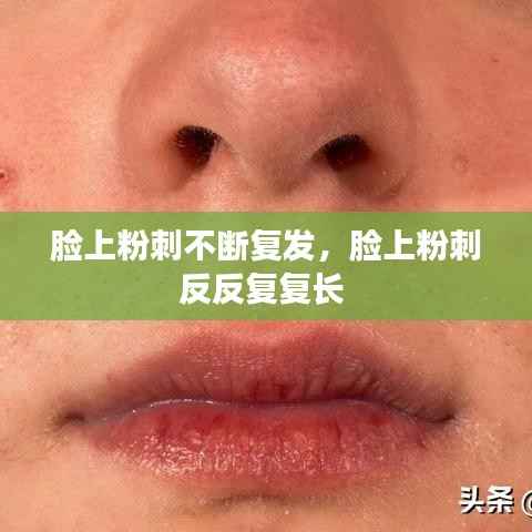 脸上粉刺不断复发，脸上粉刺反反复复长 